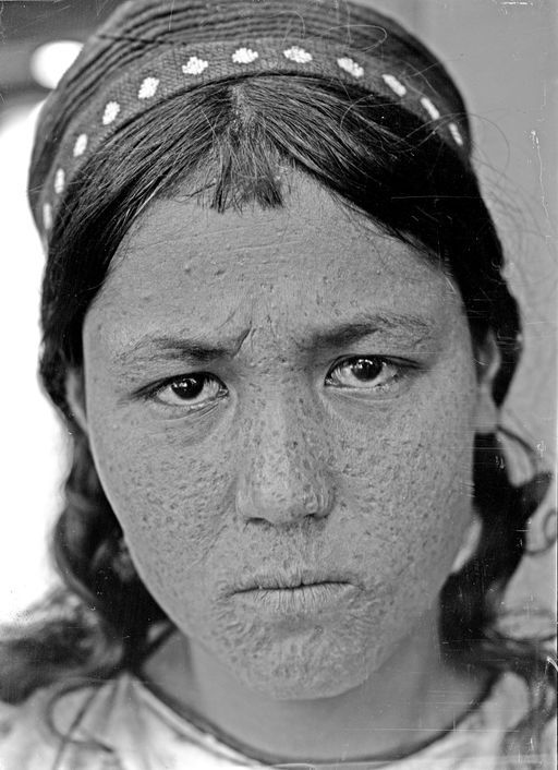 B 1485: Frau mit vernarbtem Gesicht
